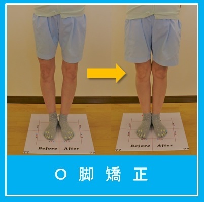可児市　O脚